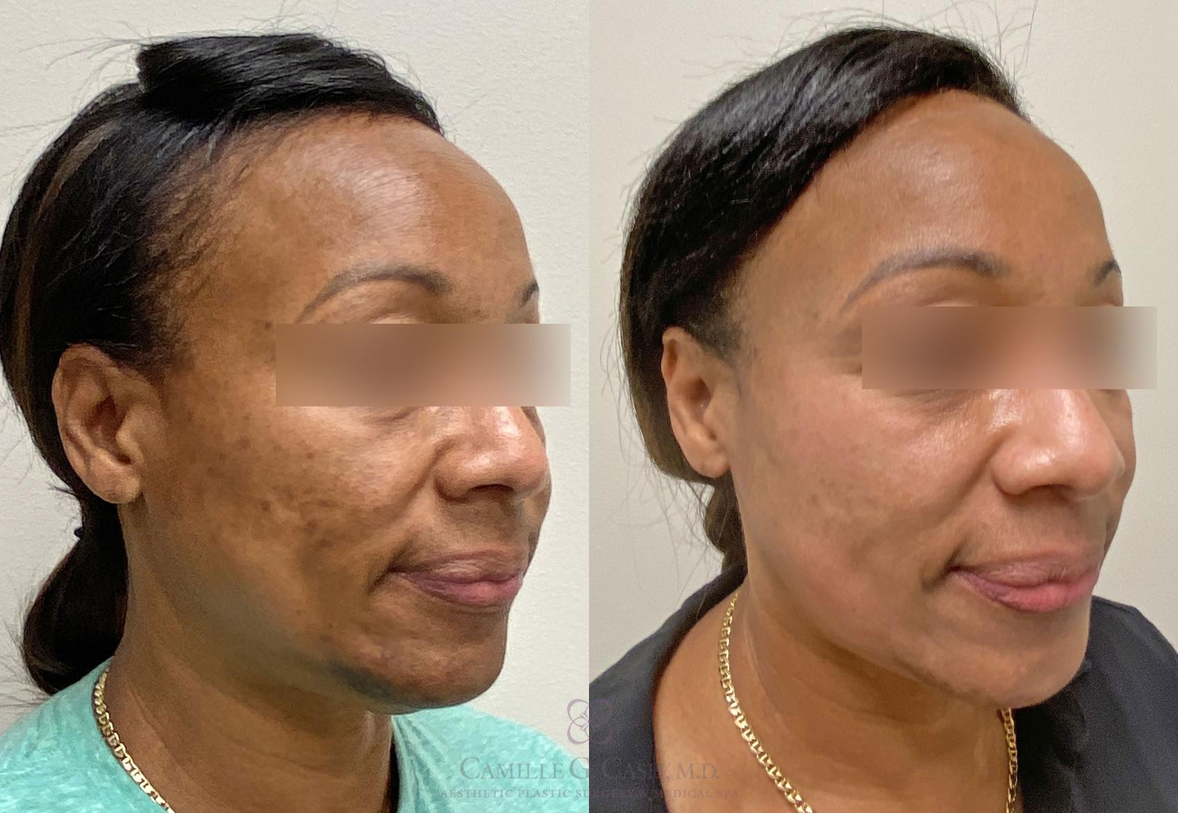Before & After Chemical Peels Case 388 View #4 View in Houston, TX