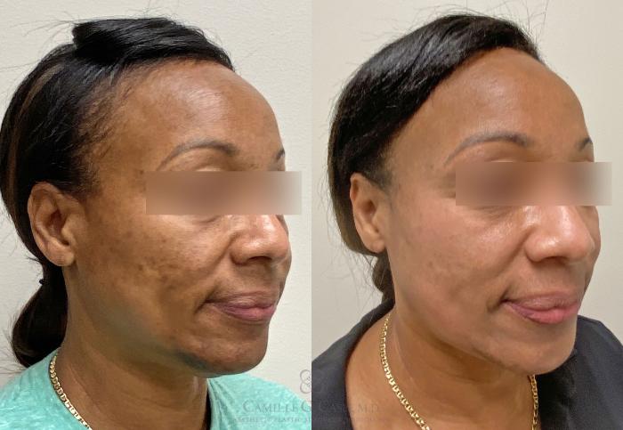 Before & After Melanage Peel Case 388 View #4 View in Houston, TX