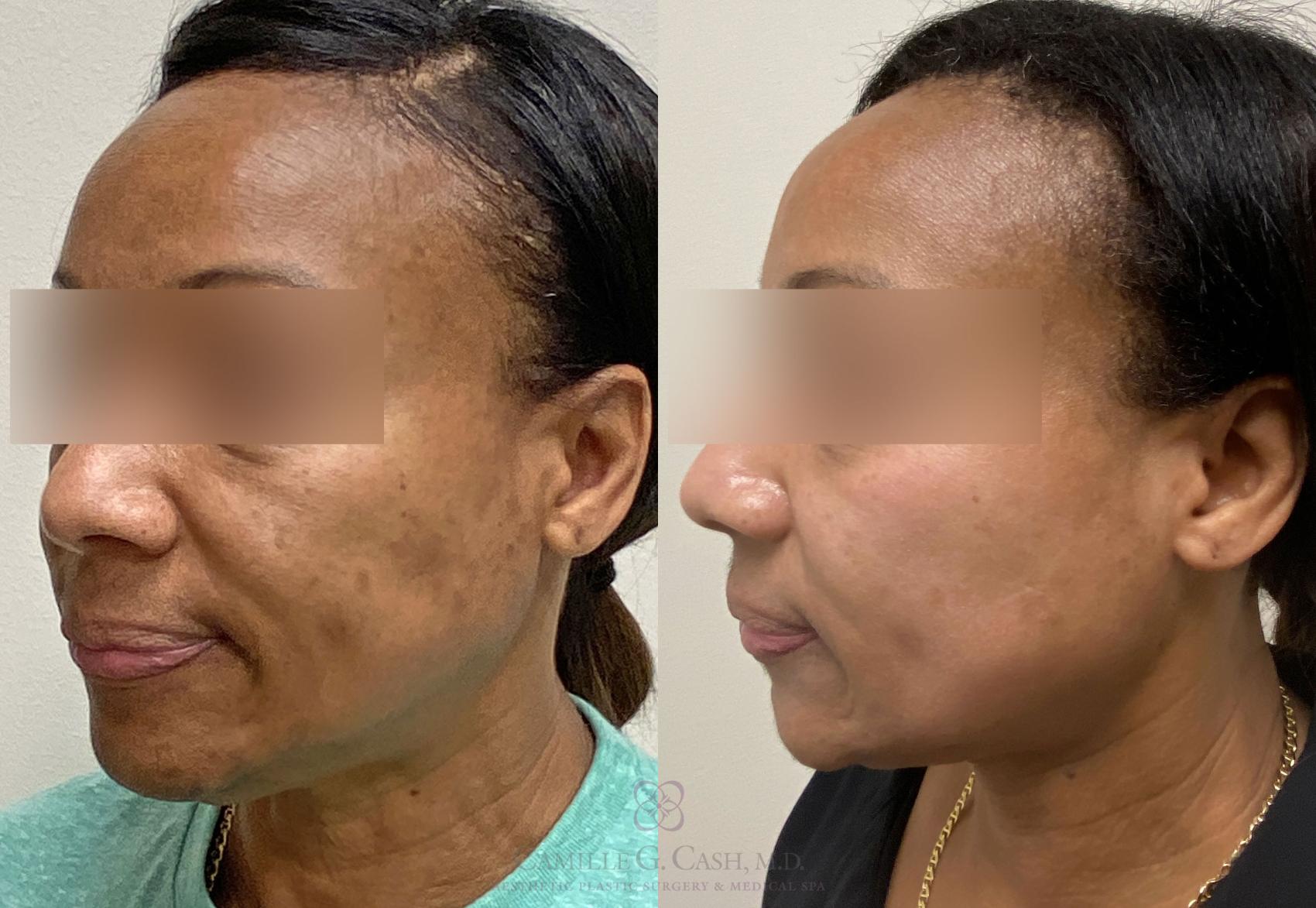 Before & After Chemical Peels Case 388 View #5 View in Houston, TX