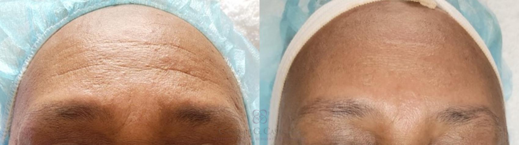 Before & After Chemical Peels Case 481 Front View in Houston, TX