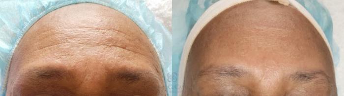 Before & After Chemical Peels Case 481 Front View in Houston, TX