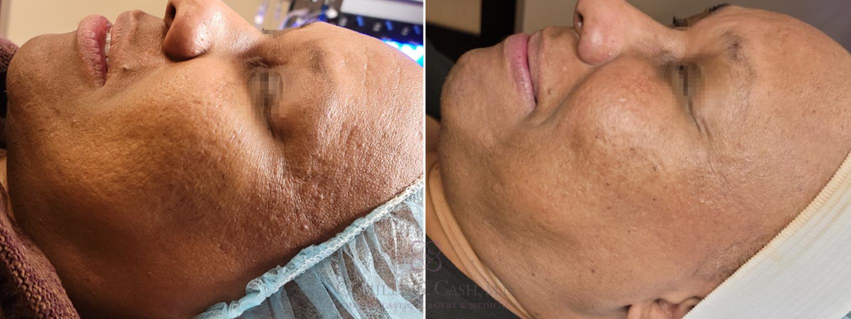 Before & After Chemical Peels Case 481 Left Side View in Houston, TX