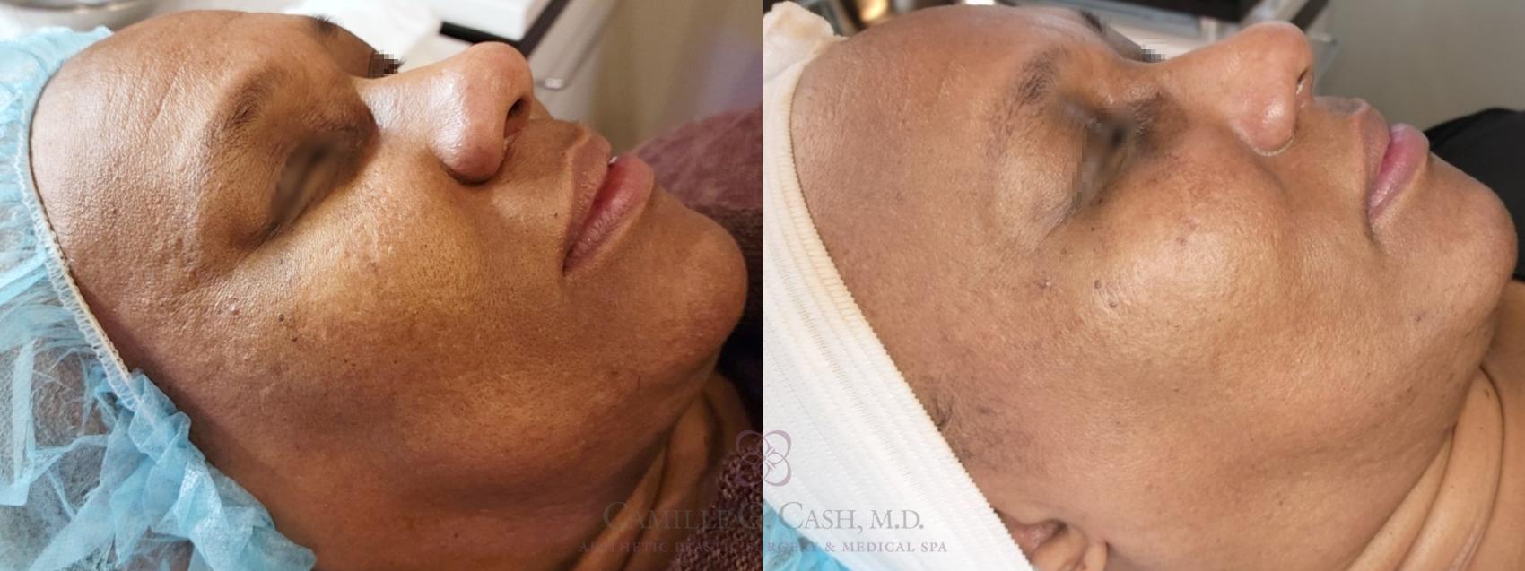 Before & After Chemical Peels Case 481 Right Side View in Houston, TX