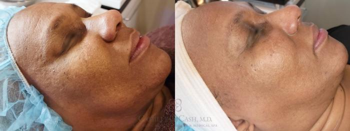 Before & After Skin Care Case 481 Right Side View in Houston, TX
