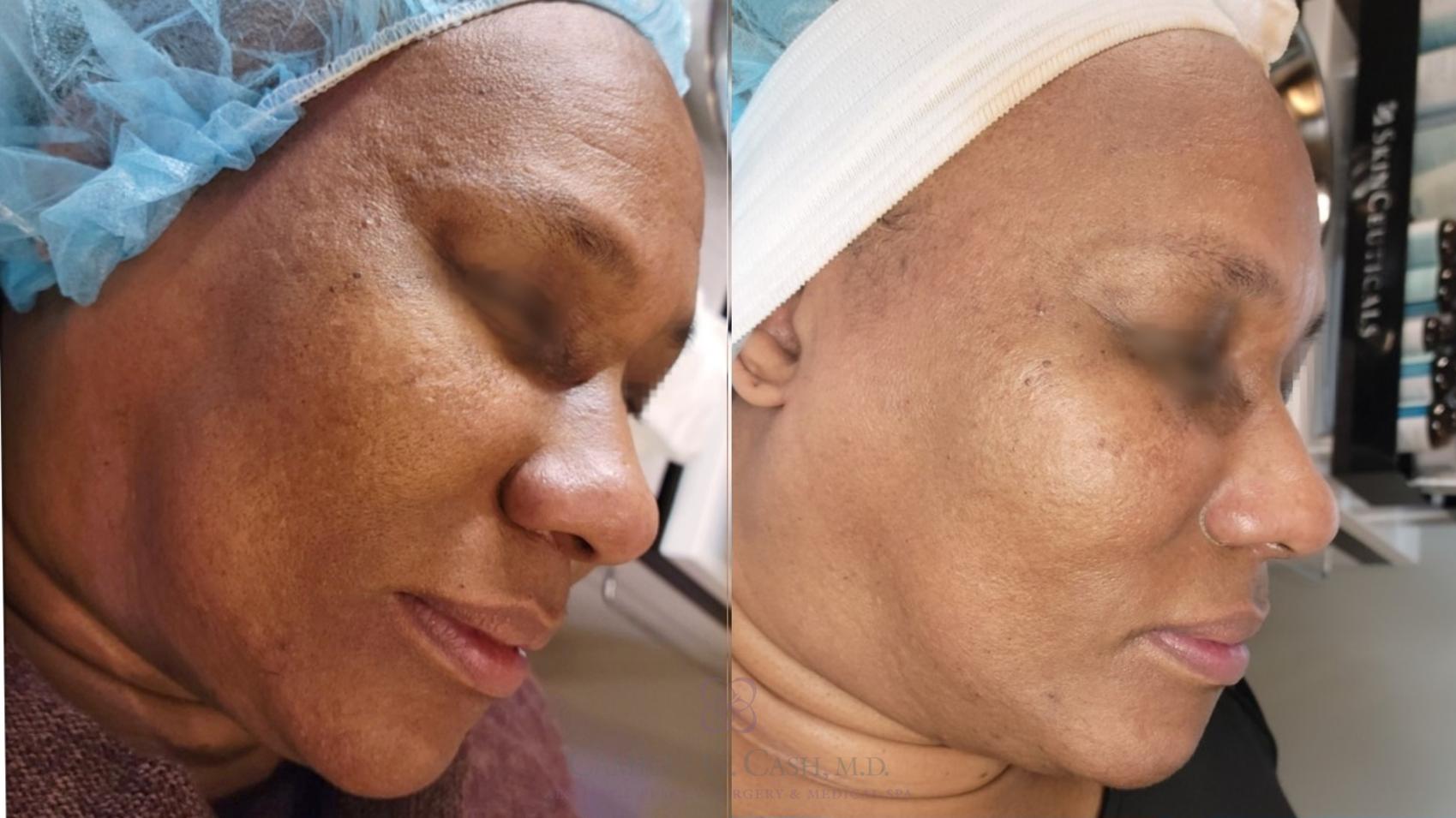 Before & After Chemical Peels Case 481 side 2 View in Houston, TX