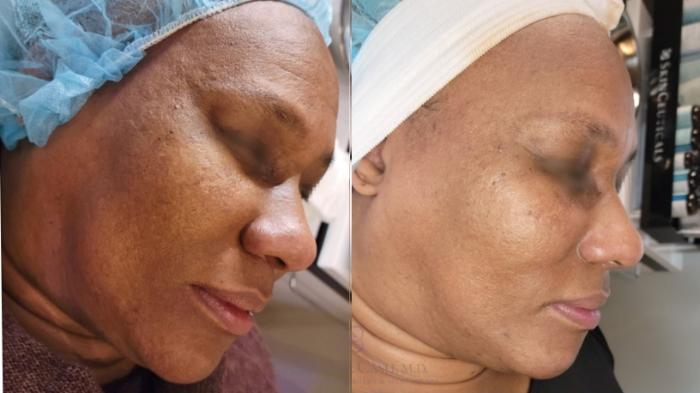 Before & After Skin Care Case 481 side 2 View in Houston, TX