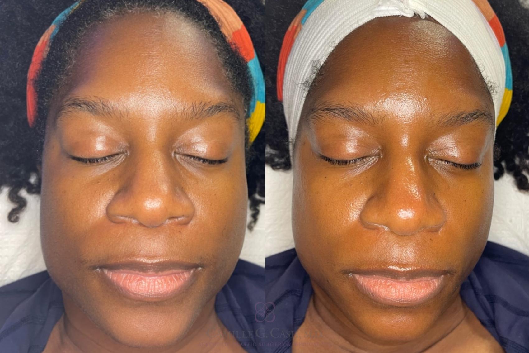Before & After Chemical Peels Case 486 Front View in Houston, TX