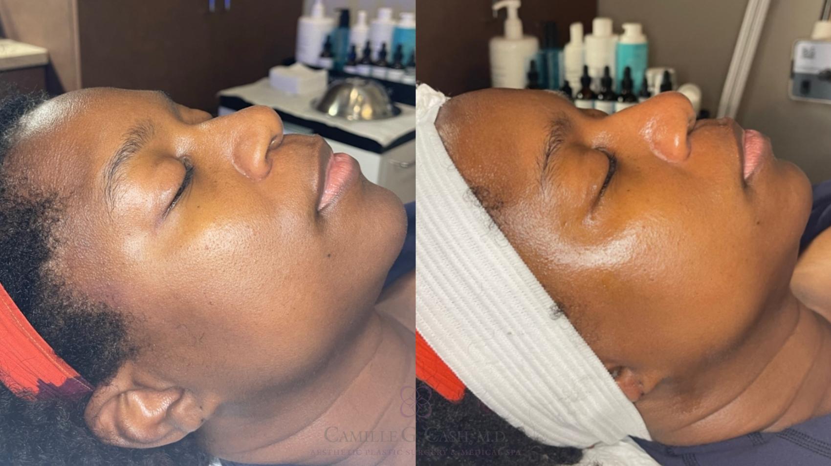 Before & After Chemical Peels Case 486 Right Side View in Houston, TX