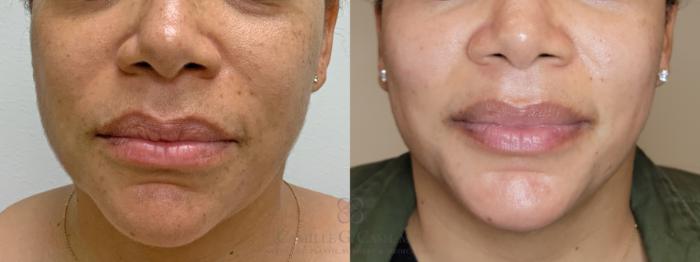 Before & After Melanage Peel Case 524 front lower face View in Houston, TX