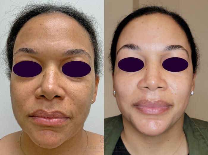 Before & After Melanage Peel Case 524 Front View in Houston, TX