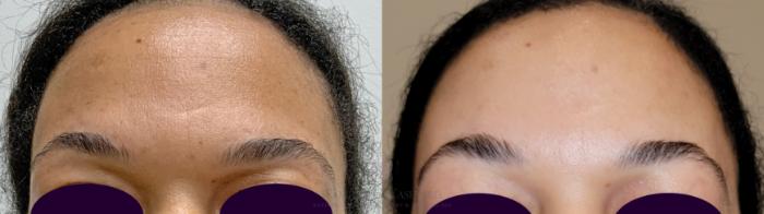 Before & After Chemical Peels Case 524 front top View in Houston, TX