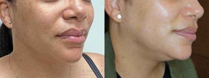 Before & After Skin Care Case 524 Left Oblique View in Houston, TX