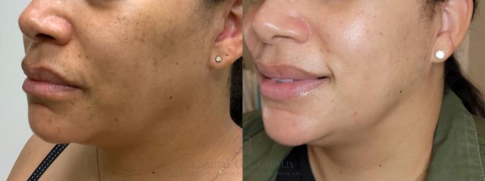 Before & After Melanage Peel Case 524 Right Oblique View in Houston, TX