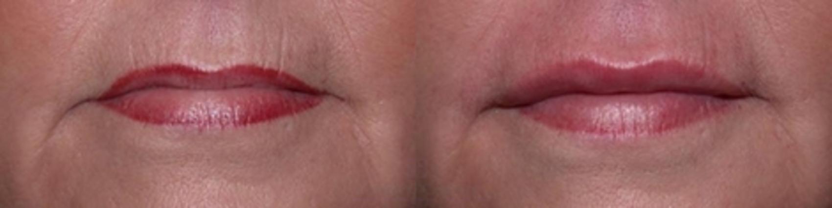 Before & After Dermal Fillers Case 113 View #1 View in Houston, TX