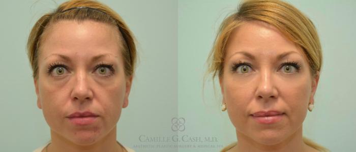 Before & After Dermal Fillers Case 142 View #1 View in Houston, TX