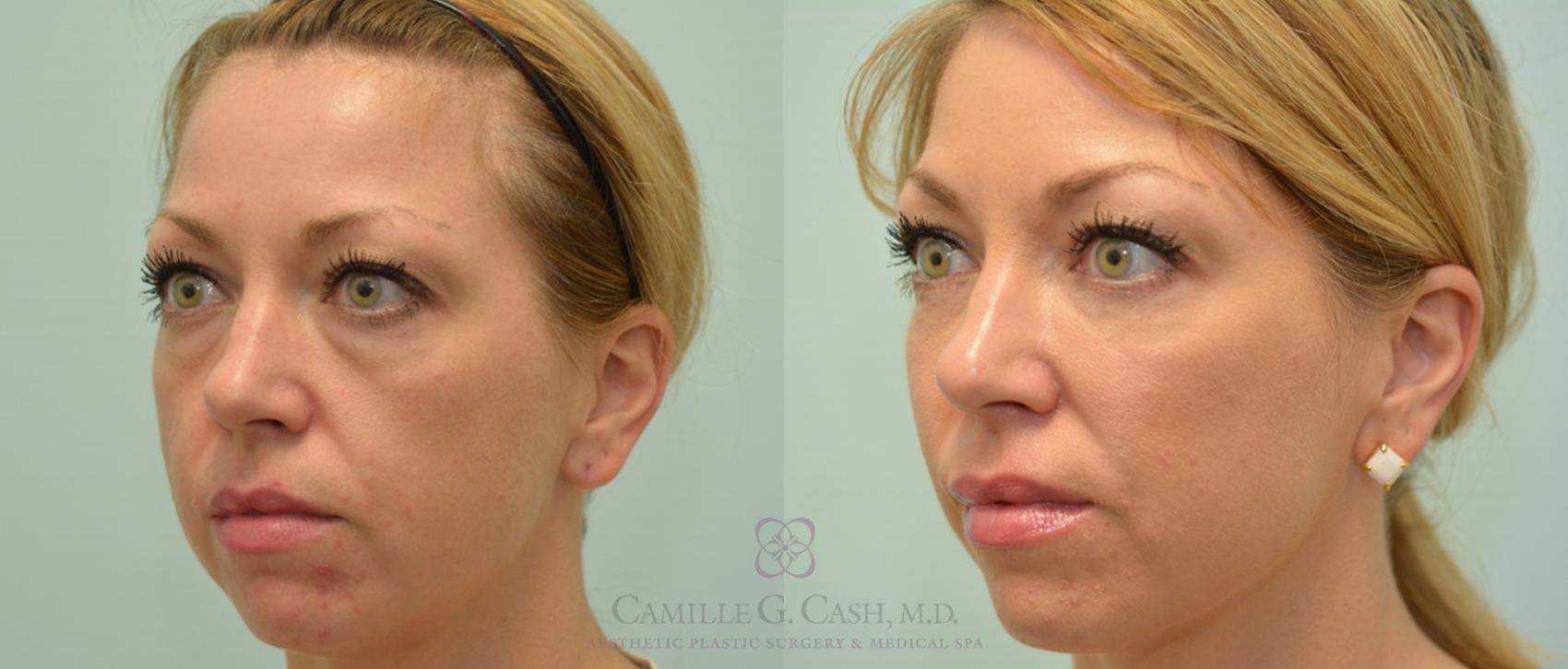 Before & After Dermal Fillers Case 142 View #2 View in Houston, TX