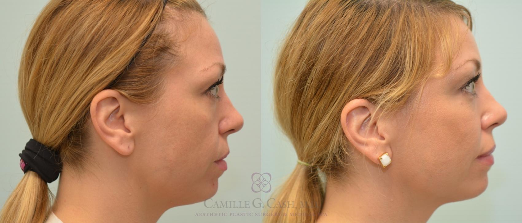Before & After Dermal Fillers Case 142 View #3 View in Houston, TX