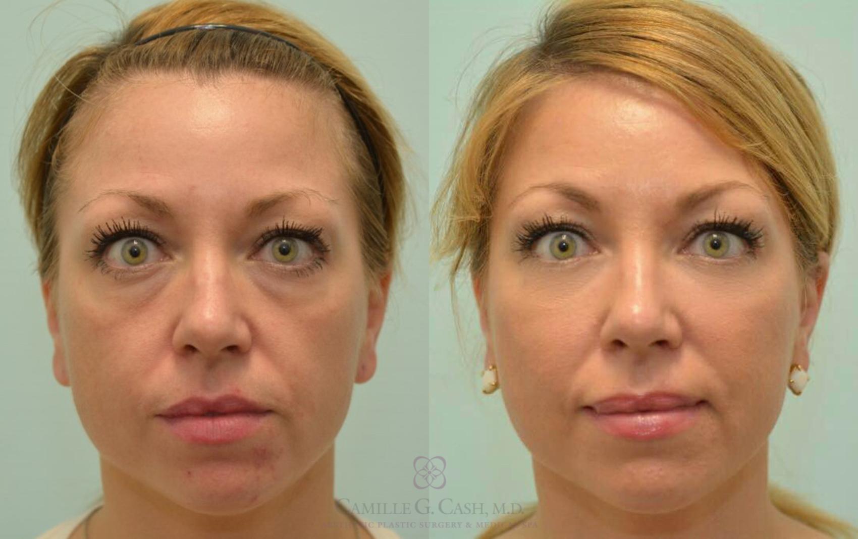 Before & After Dermal Fillers Case 142 View #4 View in Houston, TX