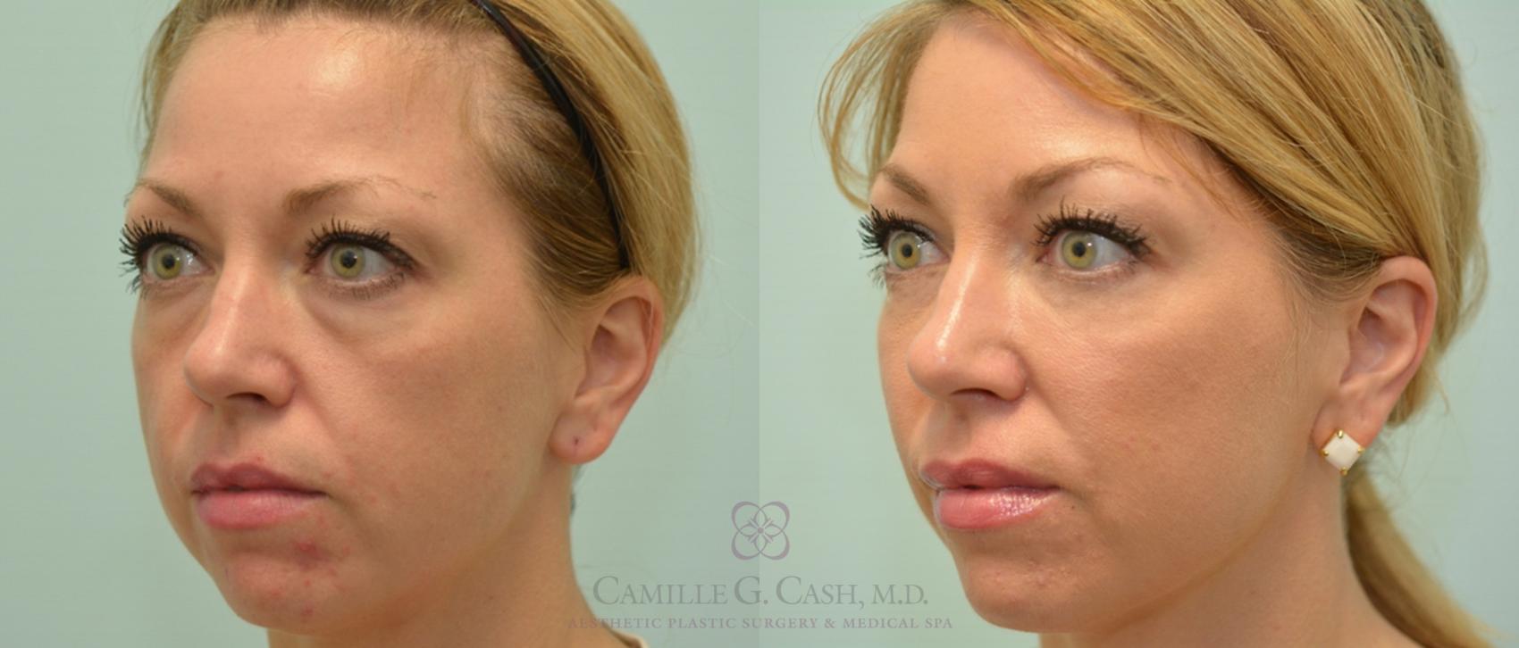 Before & After Dermal Fillers Case 142 View #5 View in Houston, TX