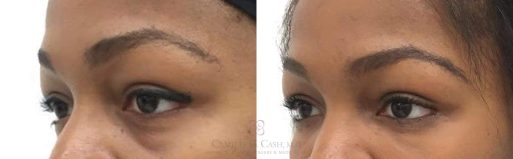 Before & After Dermal Fillers Case 183 View #1 View in Houston, TX