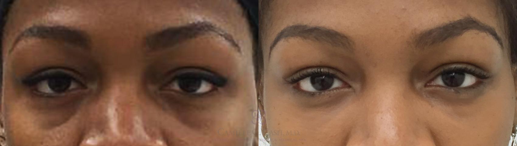 Before & After Dermal Fillers Case 183 View #2 View in Houston, TX