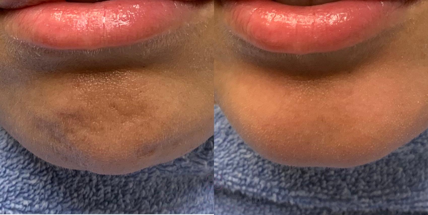 Before & After Dermal Fillers Case 221 View #1 View in Houston, TX