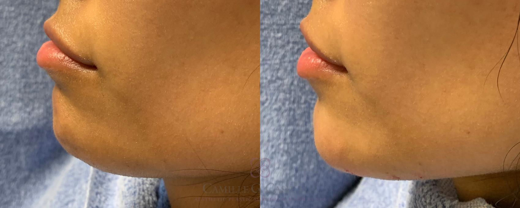 Before & After Dermal Fillers Case 221 View #2 View in Houston, TX