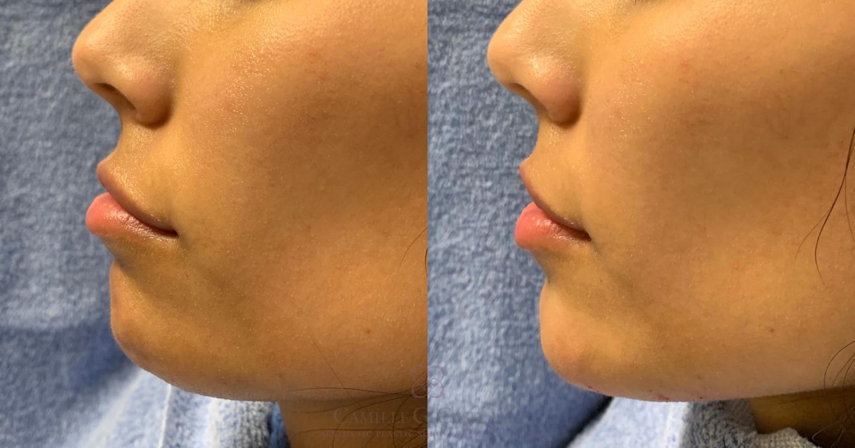 Before & After Dermal Fillers Case 221 View #3 View in Houston, TX