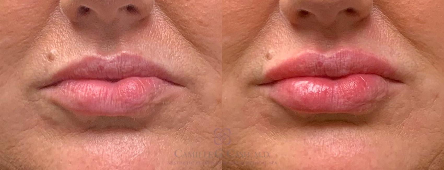 Before & After Dermal Fillers Case 223 View #1 View in Houston, TX