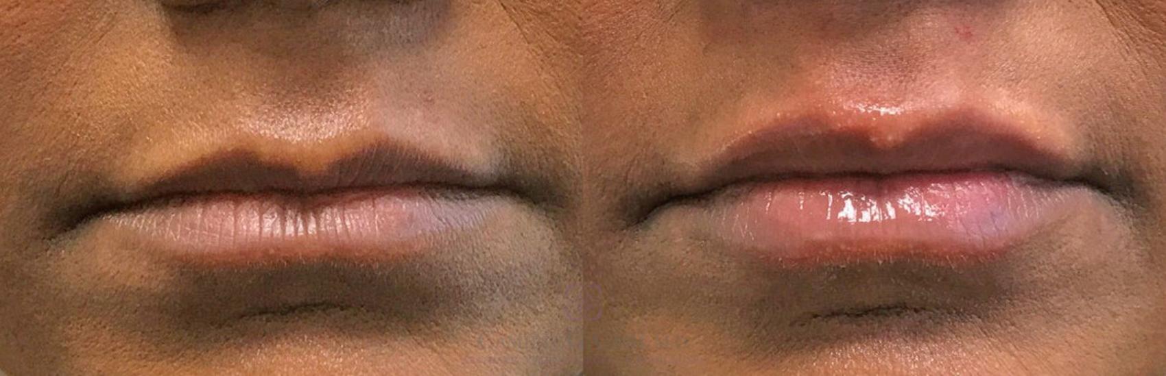 Before & After Dermal Fillers Case 320 View #1 View in Houston, TX