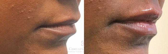 Before & After Dermal Fillers Case 320 View #2 View in Houston, TX