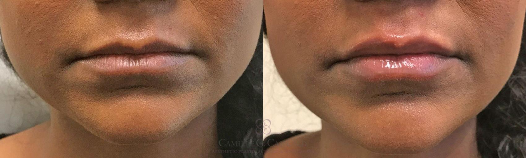 Before & After Dermal Fillers Case 320 View #3 View in Houston, TX