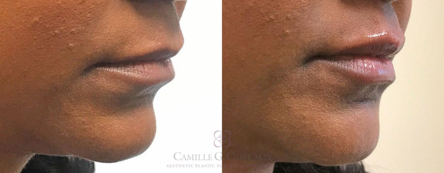 Before & After Dermal Fillers Case 320 View #4 View in Houston, TX