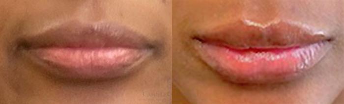 Before & After Dermal Fillers Case 350 View #1 View in Houston, TX