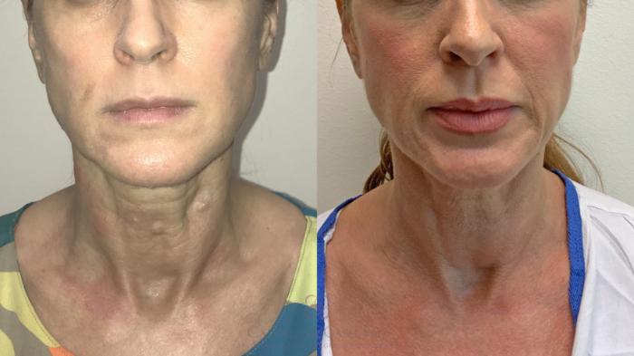 Before & After Dermal Fillers Case 355 front 2 View in Houston, TX