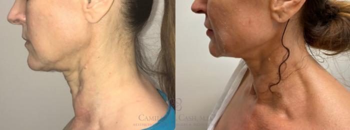 Before & After Dermal Fillers Case 355 Left Side View in Houston, TX