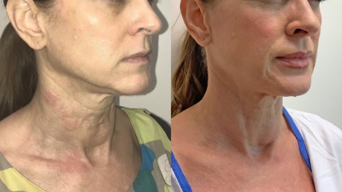 Before & After Dermal Fillers Case 355 Right Oblique View in Houston, TX