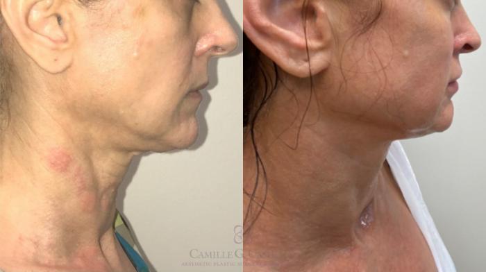 Before & After Dermal Fillers Case 355 Right Side View in Houston, TX