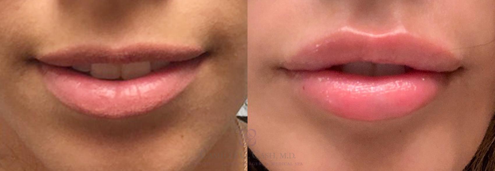 Before & After Dermal Fillers Case 375 View #1 View in Houston, TX