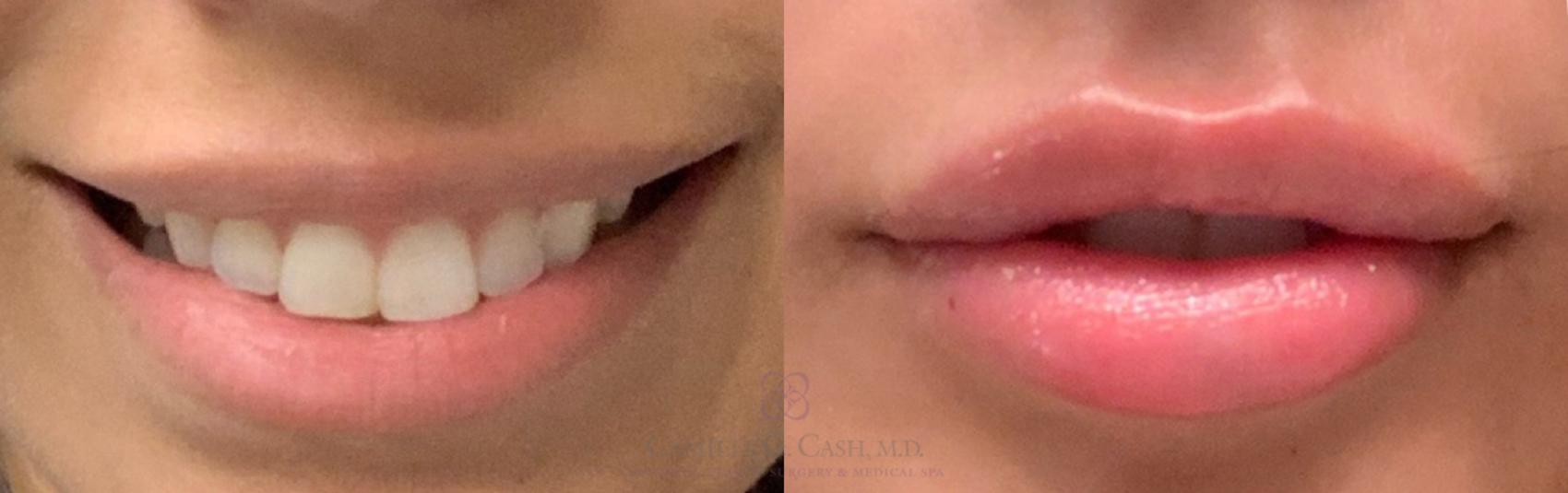 Before & After Dermal Fillers Case 375 View #2 View in Houston, TX