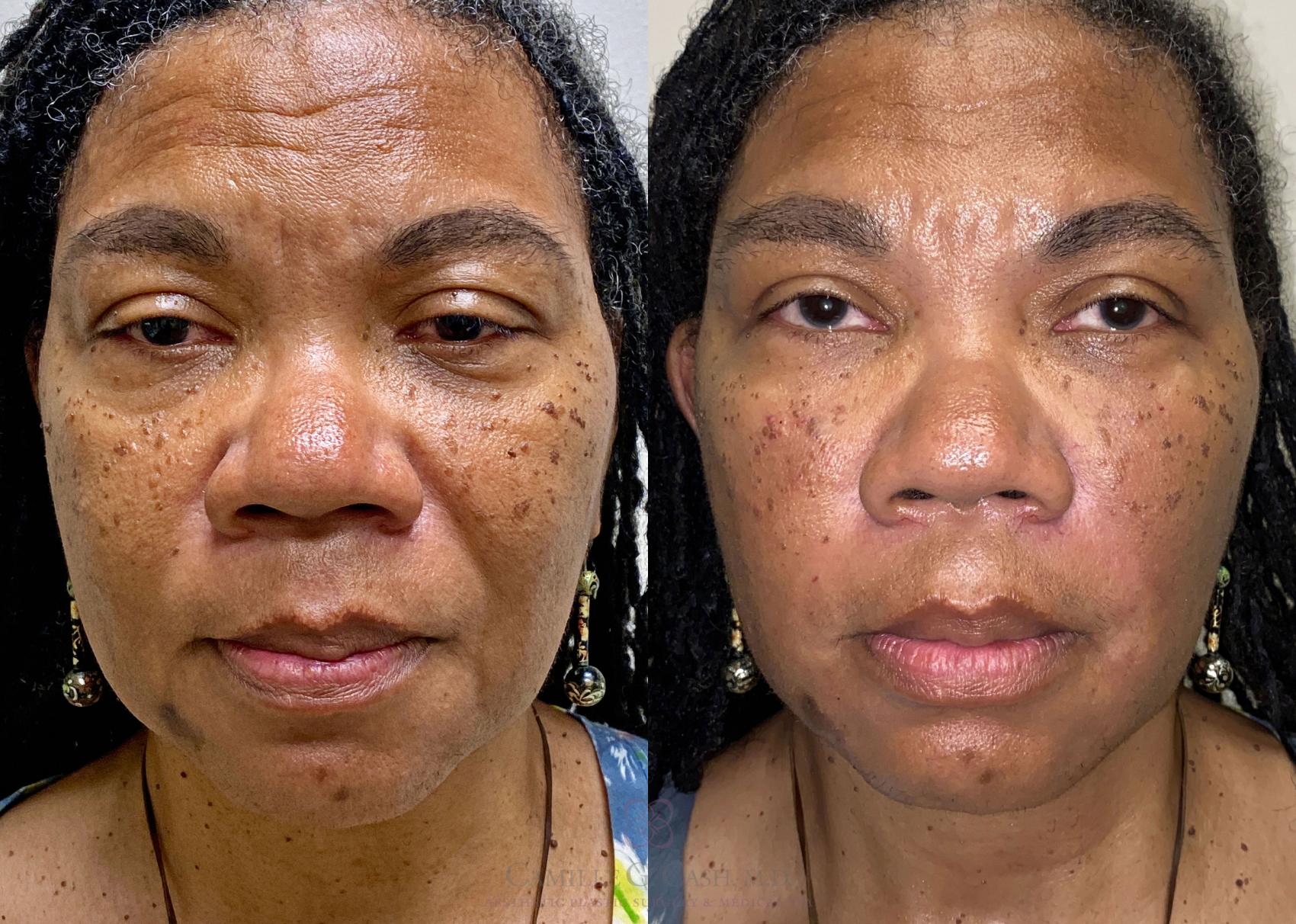 Before & After Dermal Fillers Case 380 View #1 View in Houston, TX