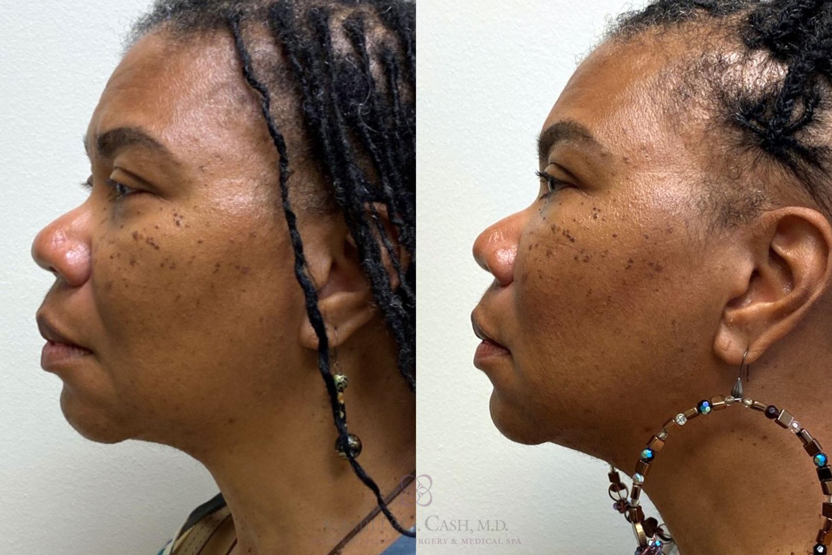 Before & After Dermal Fillers Case 380 View #2 View in Houston, TX