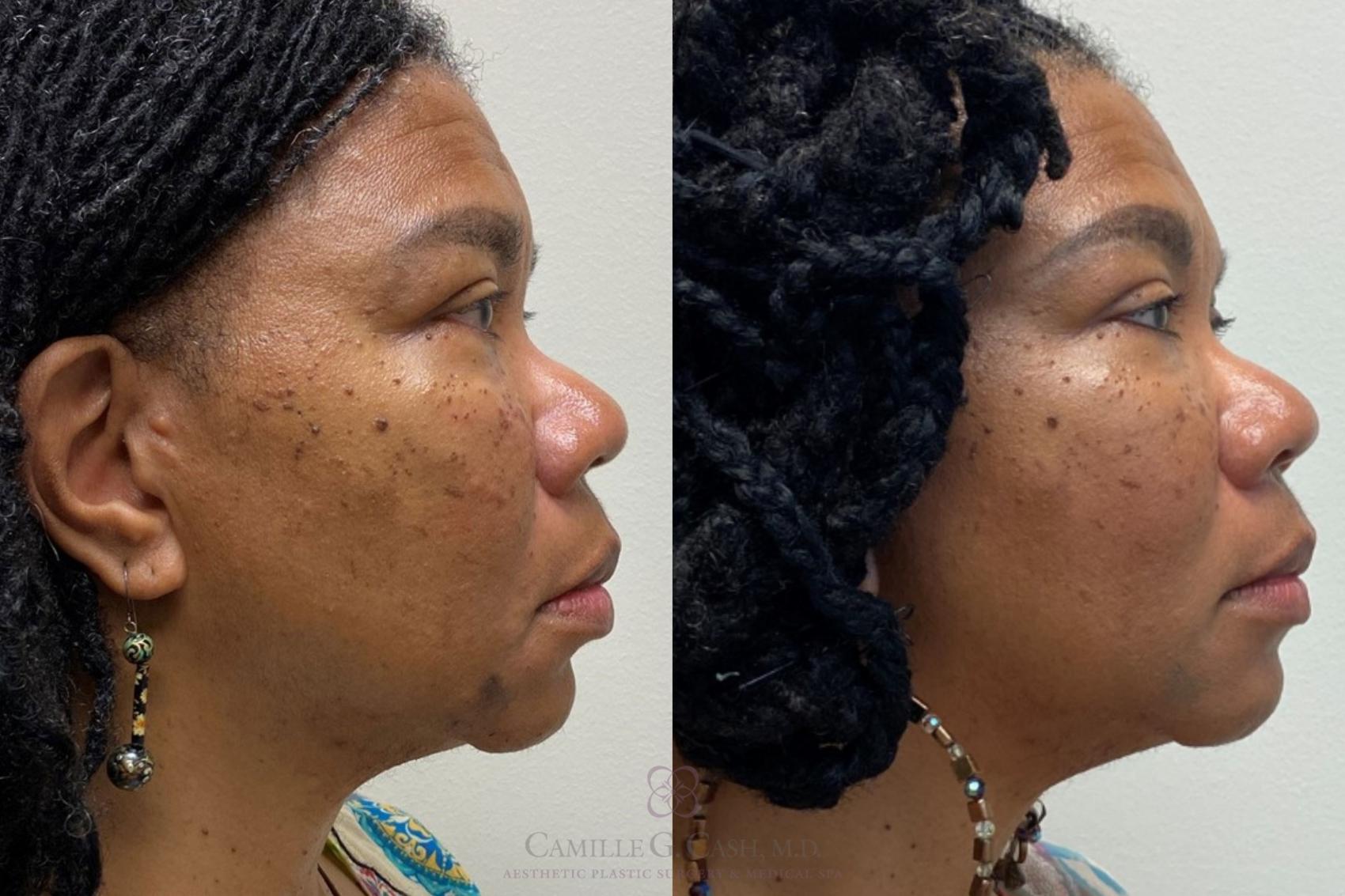 Before & After Dermal Fillers Case 380 View #3 View in Houston, TX