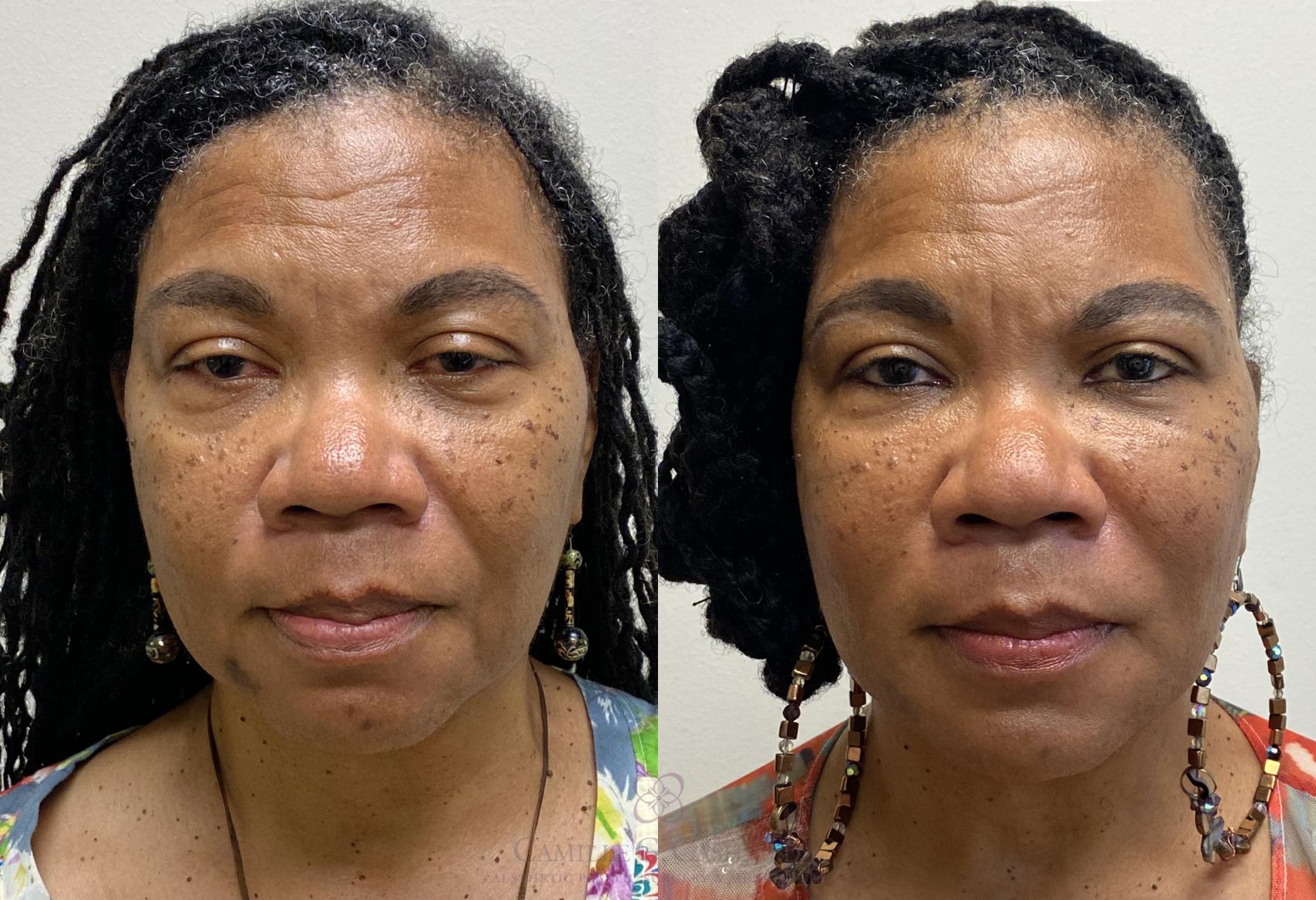 Before & After Dermal Fillers Case 380 View #4 View in Houston, TX