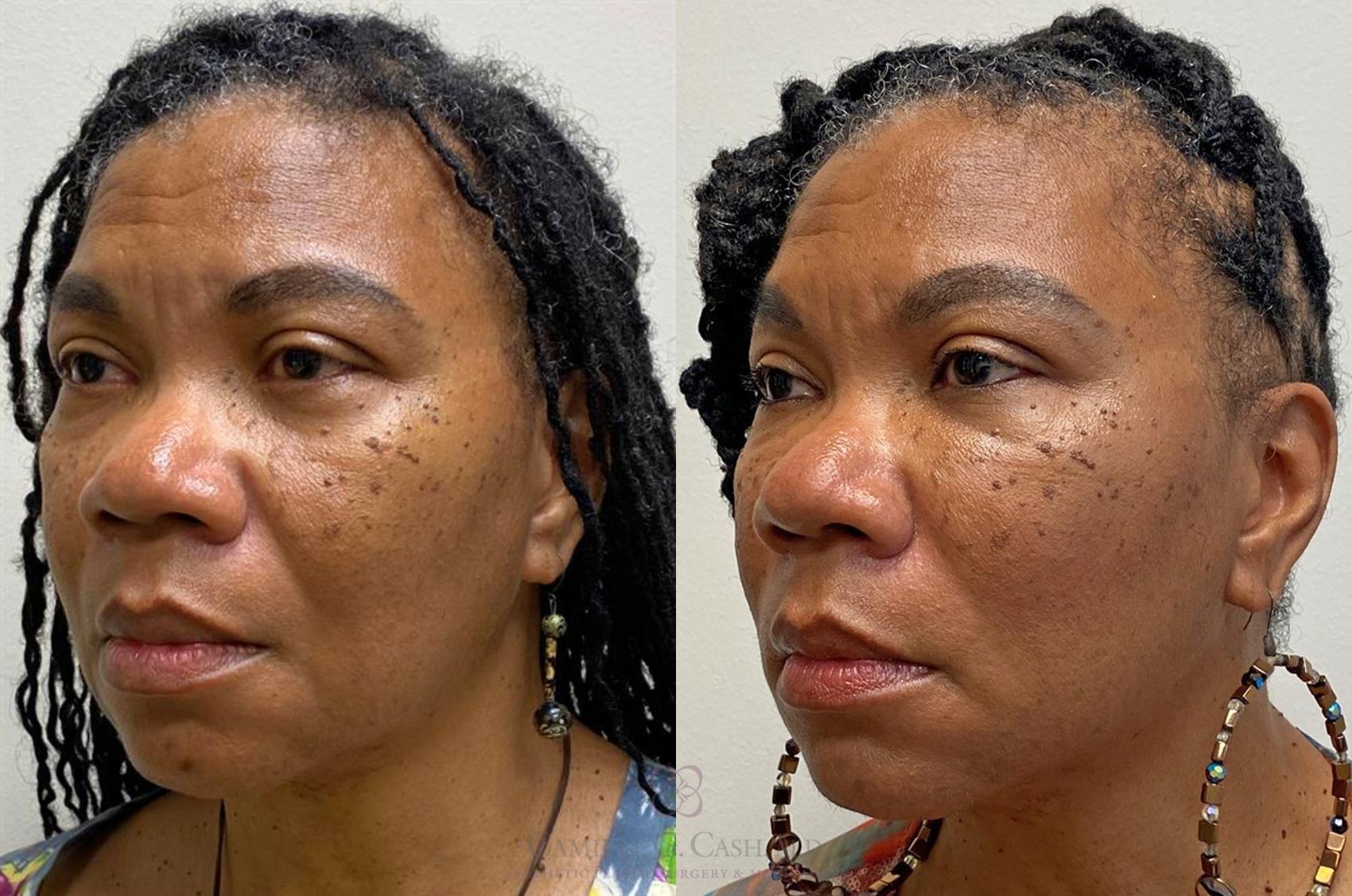 Before & After Dermal Fillers Case 380 View #5 View in Houston, TX