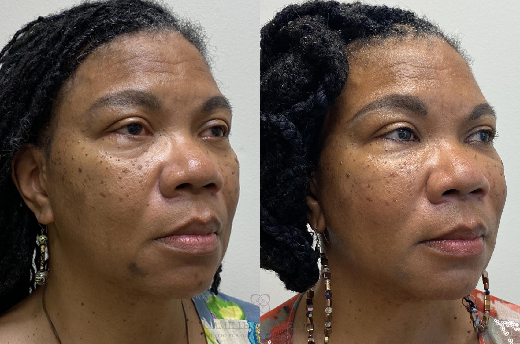 Before & After Dermal Fillers Case 380 View #6 View in Houston, TX