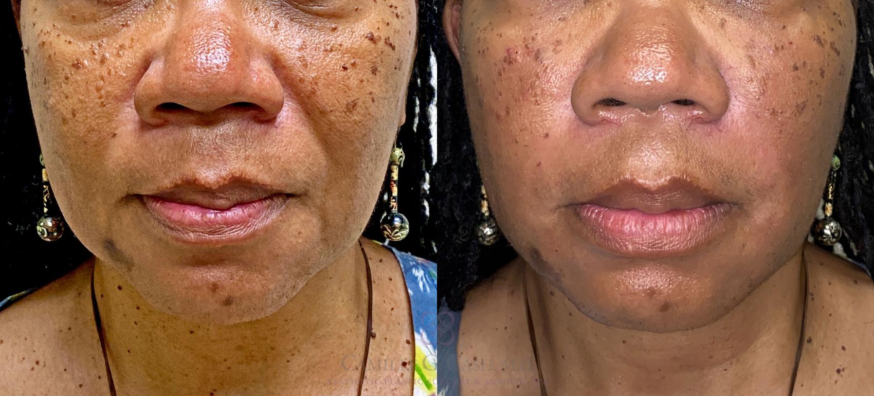 Before & After Dermal Fillers Case 380 View #7 View in Houston, TX