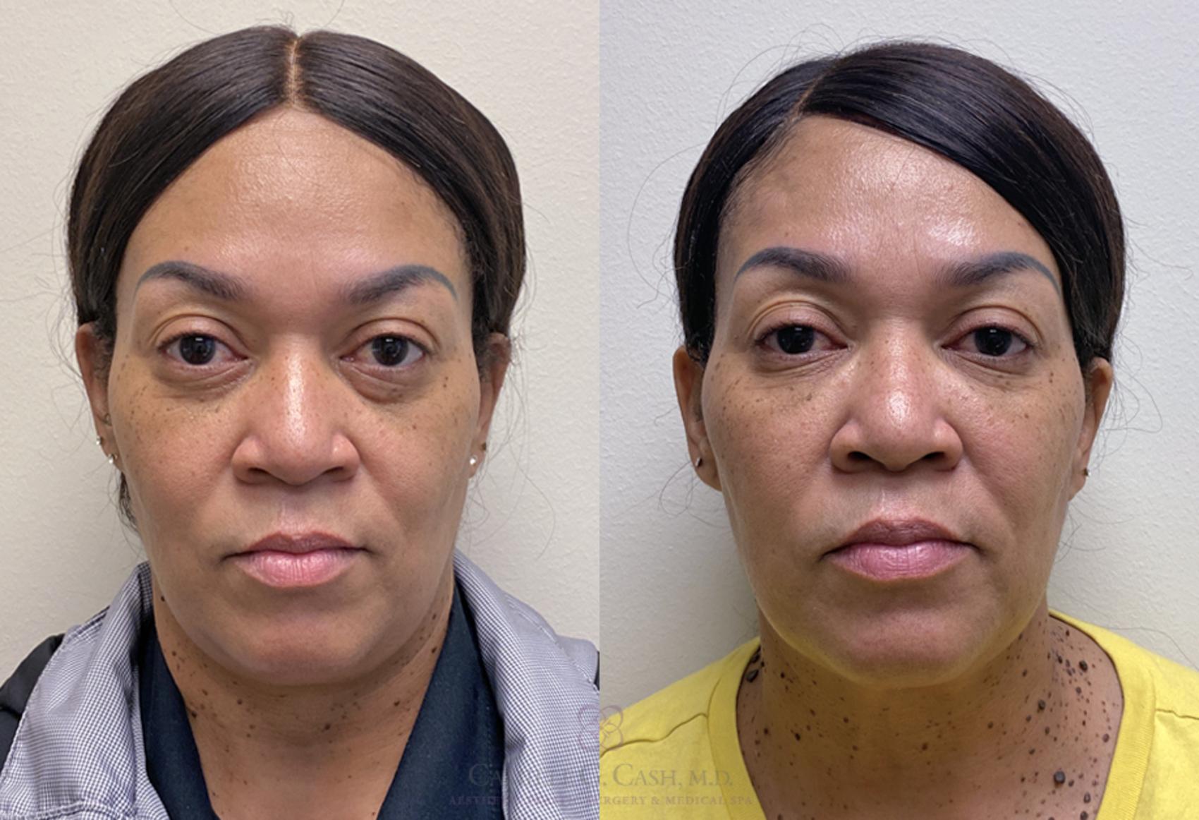 Before & After Dermal Fillers Case 381 View #1 View in Houston, TX