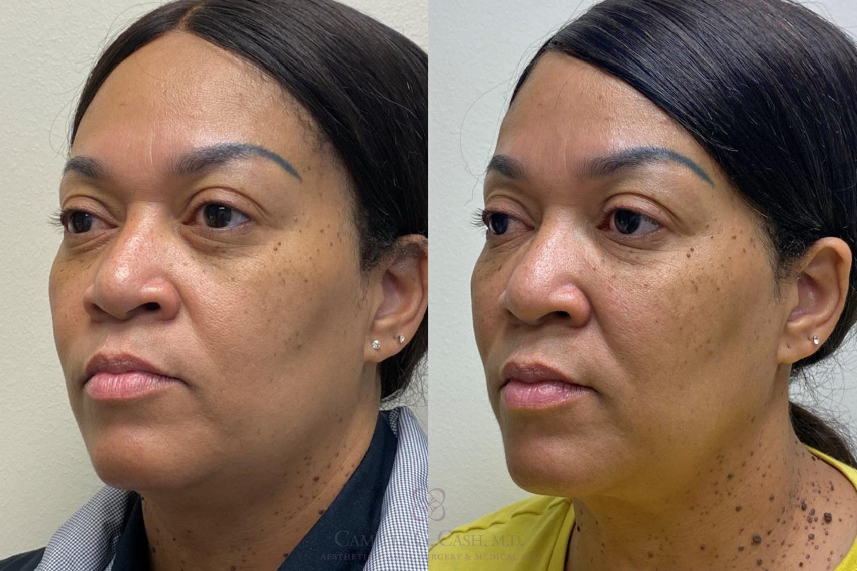 Before & After Dermal Fillers Case 381 View #2 View in Houston, TX