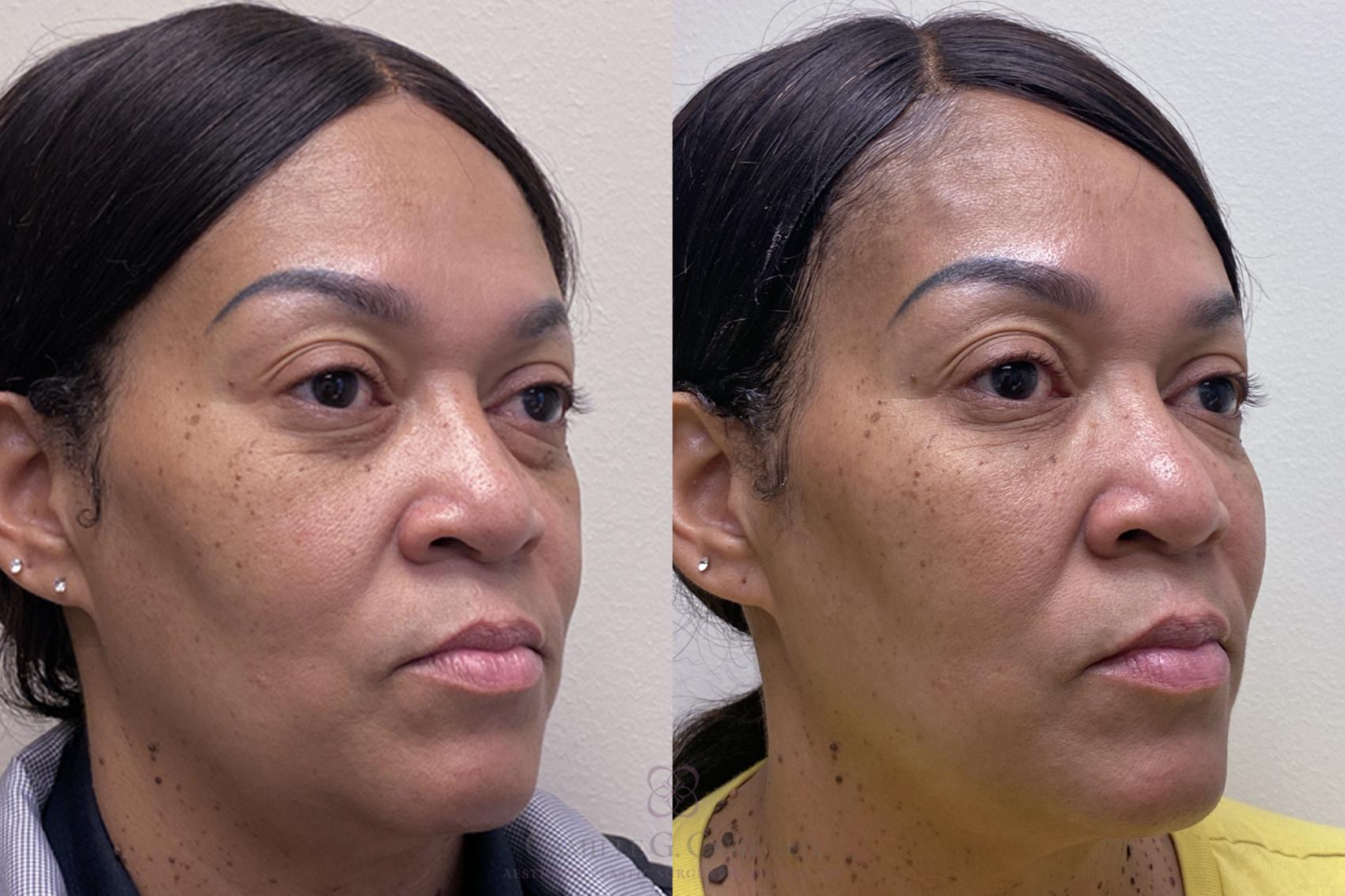 Before & After Dermal Fillers Case 381 View #3 View in Houston, TX